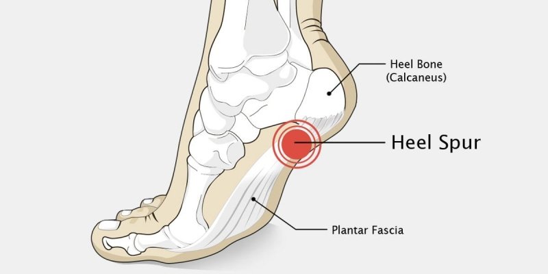 Calcaneal Spur Trearment In Gurgaon