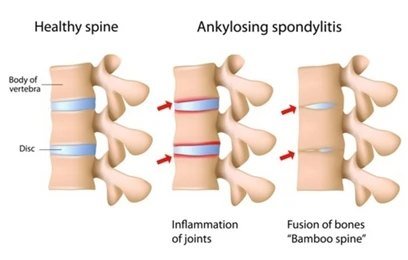 Ankylosing Spondylitis Treatment in Gurgaon