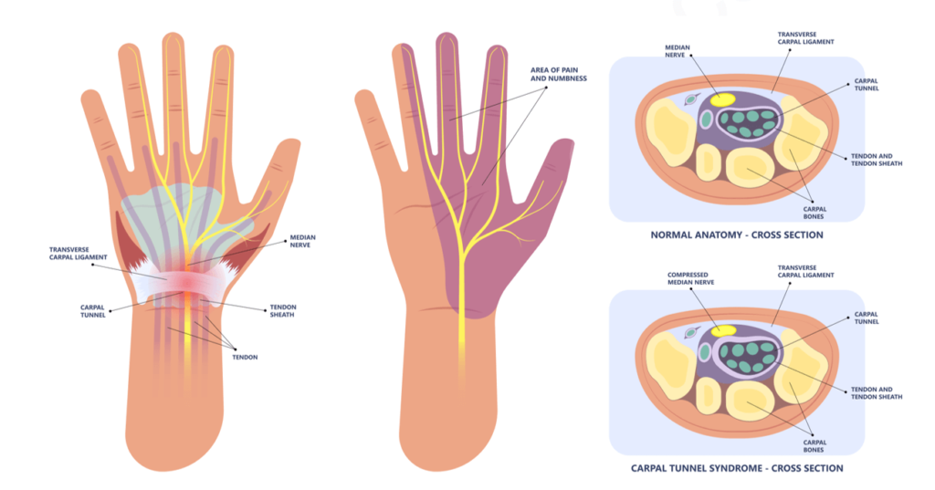 Carpal Tunnel Syndrome Treatments In Gurgaon