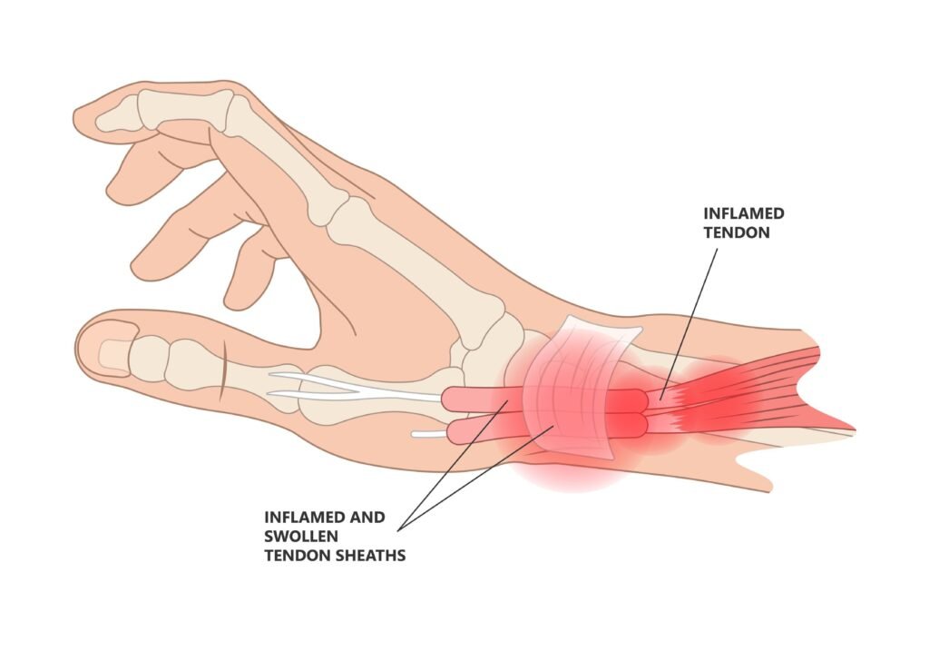 De Quervain Tenosynovitis Treatment In Gurgaon