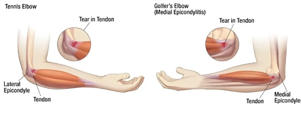 Tennis Golfers Elbow Treatment In Gurgaon