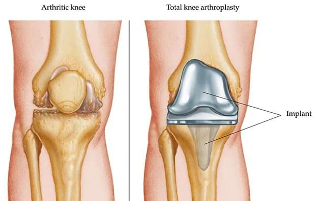 Arthroplasty Treatment In Gurgaon