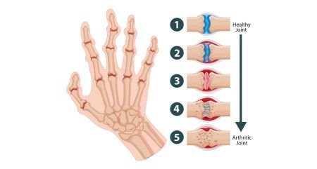 Rheumatoid Arthritis Treatment in Gurgaon