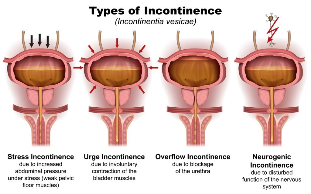 Stress Incontinence Treatment In Gurgaon