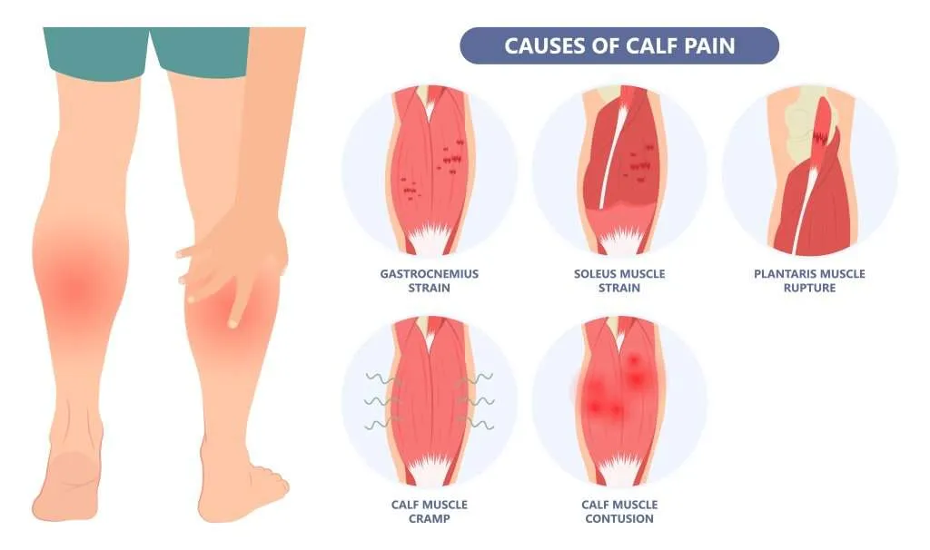 Calf Strain Treatment In Gurgaon