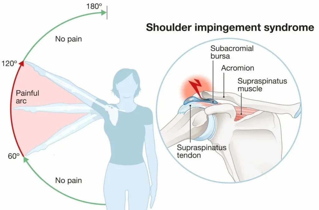 Shoulder Impingement Treatment In Gurgaon