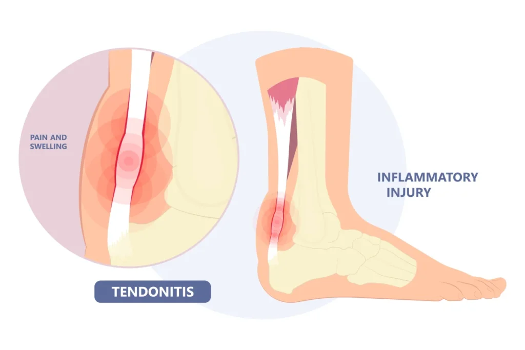 Tendonitis Treatment In Gurgaon