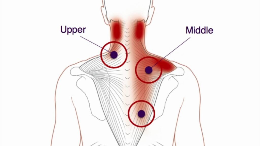 Trigger Point Pain In Gurgaon