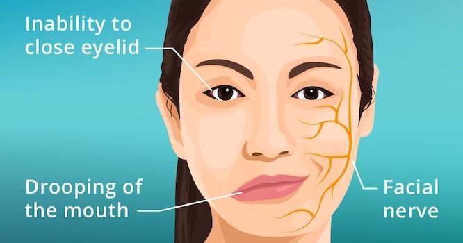 Bell's Palsy Treatment in Gurgaon