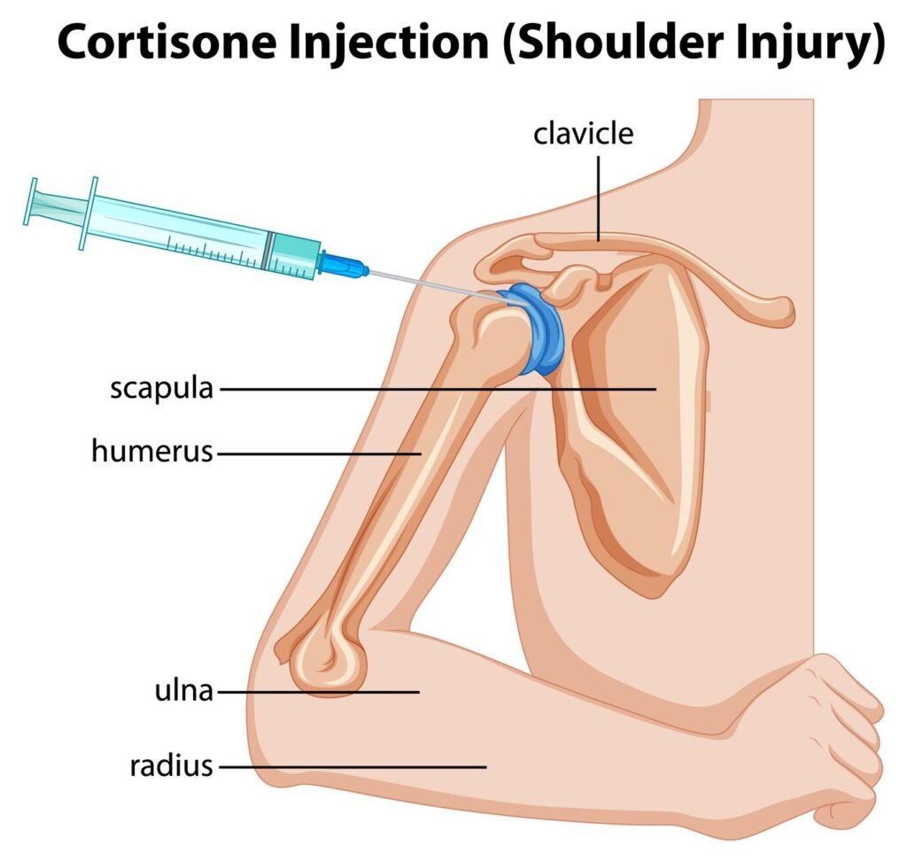 Shoulder Impingement