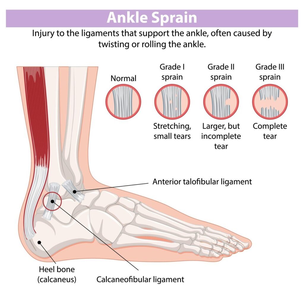 Ankle Sprain Treatment In Gurgaon